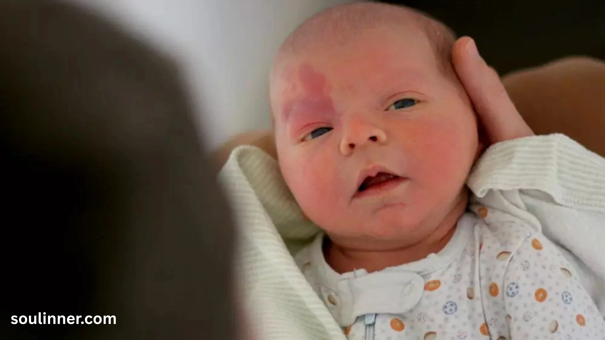 angel kiss birthmark spiritual meaning