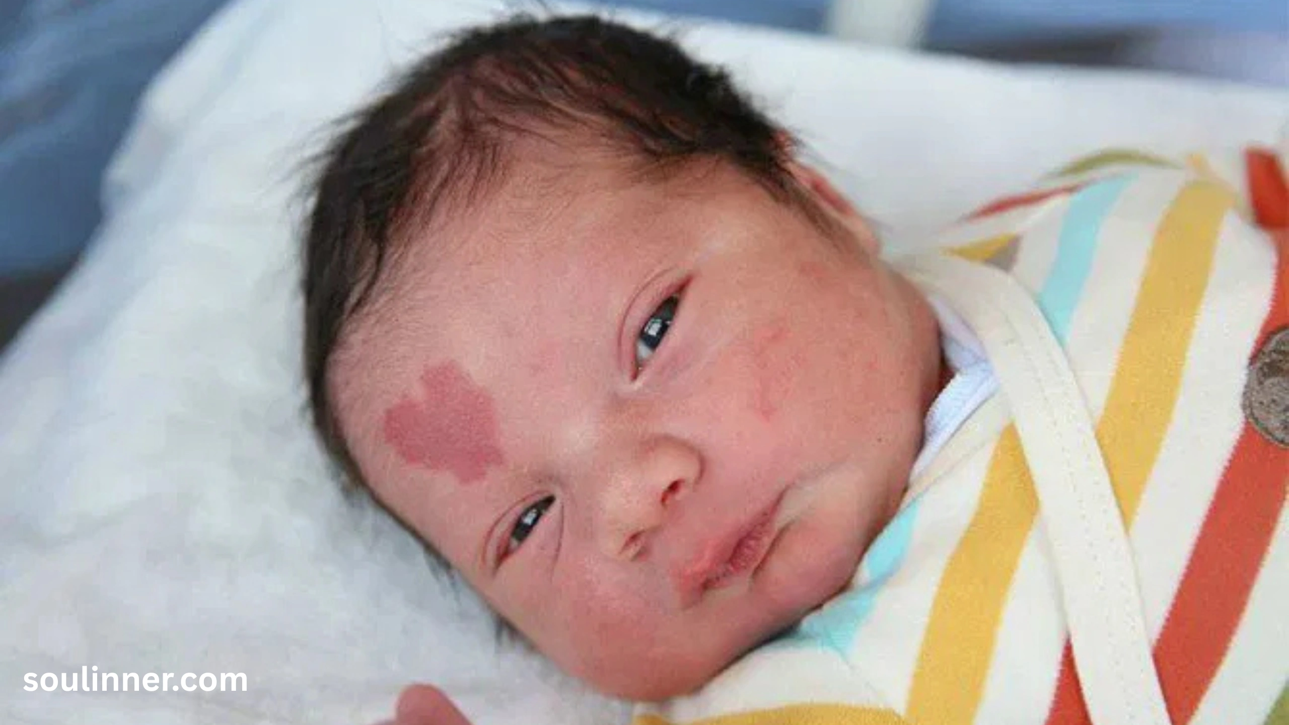 angel kiss birthmark spiritual meaning