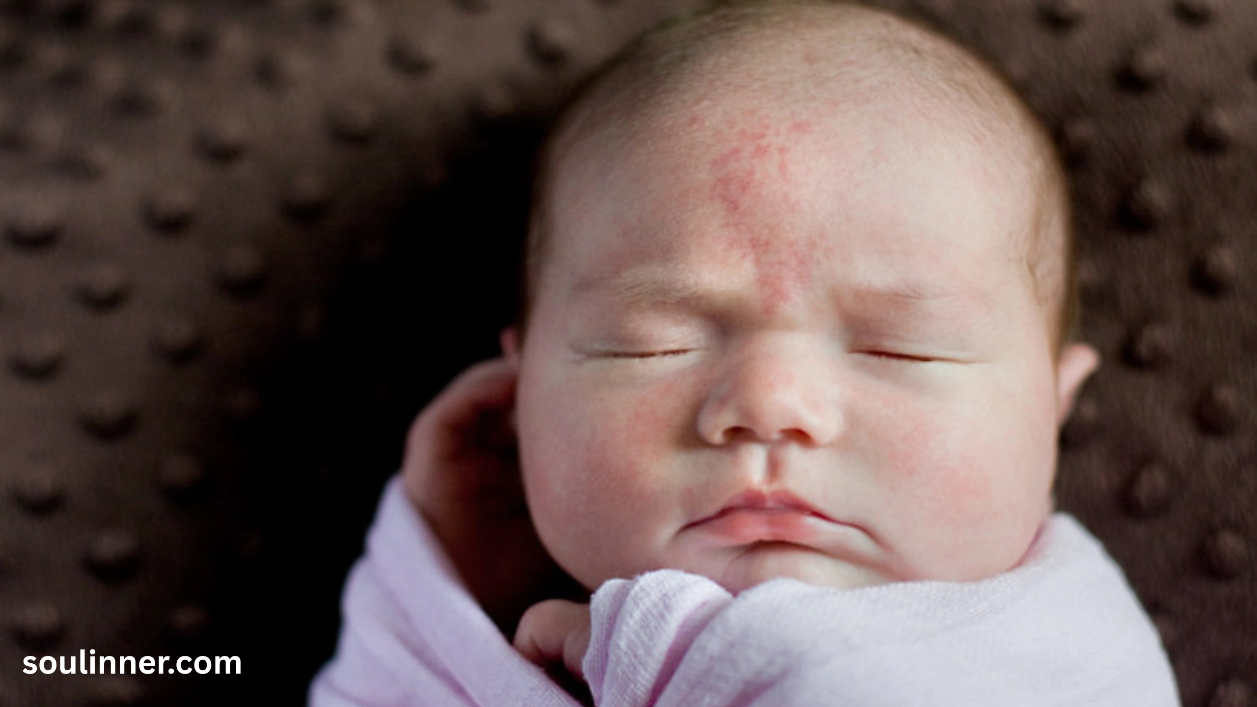 angel kiss birthmark spiritual meaning