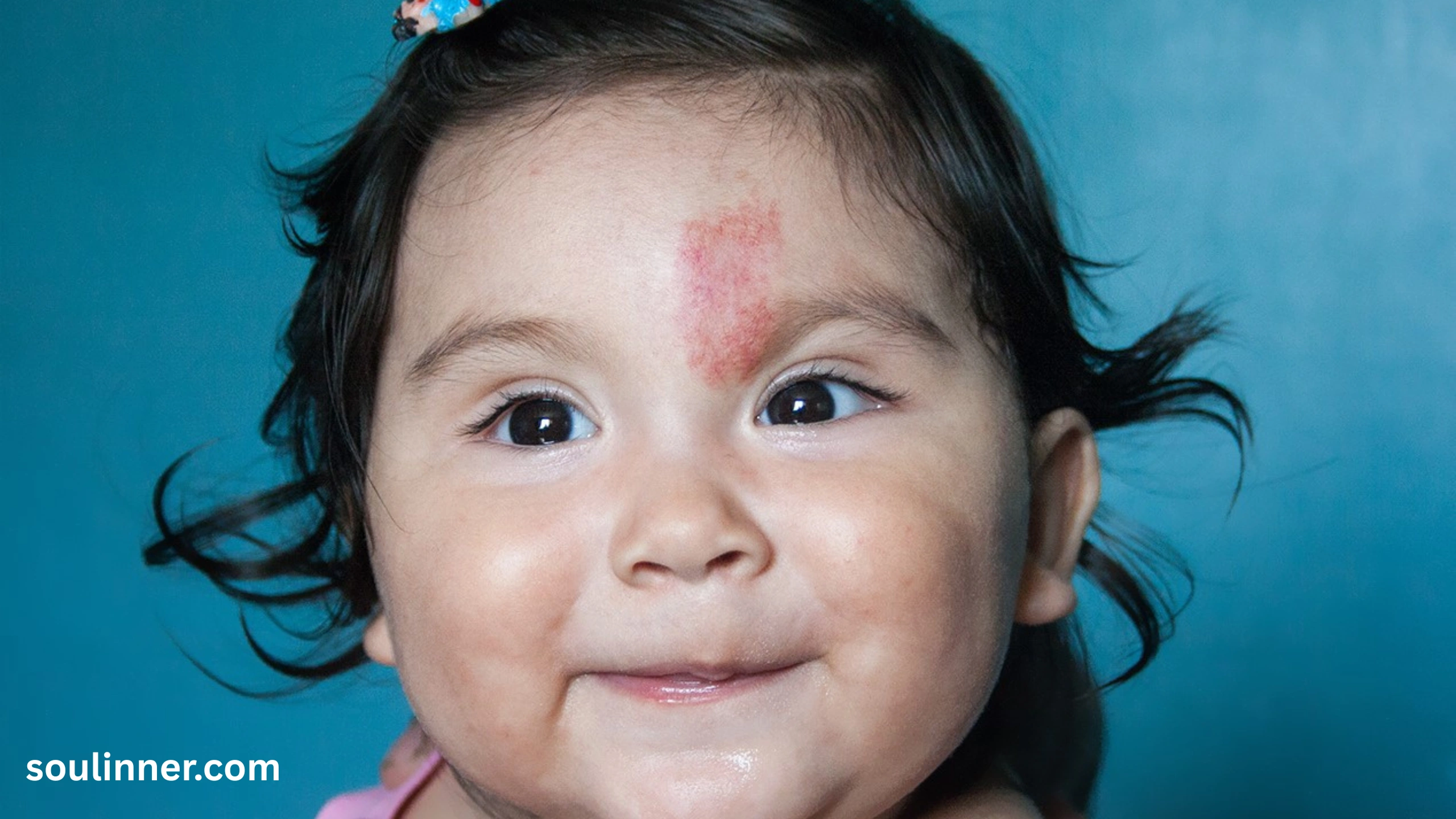 angel kiss birthmark spiritual meaning