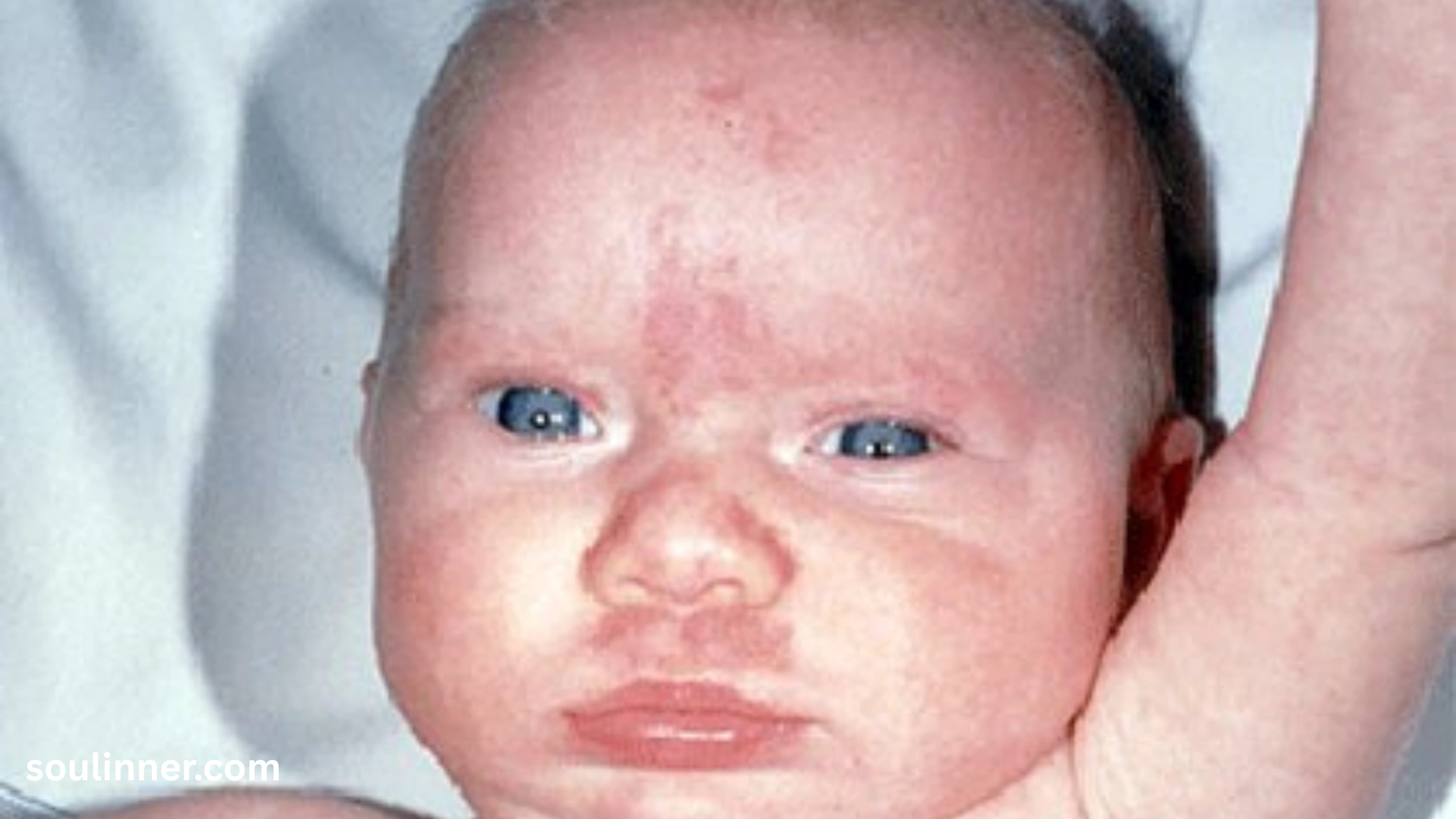 angel kiss birthmark spiritual meaning