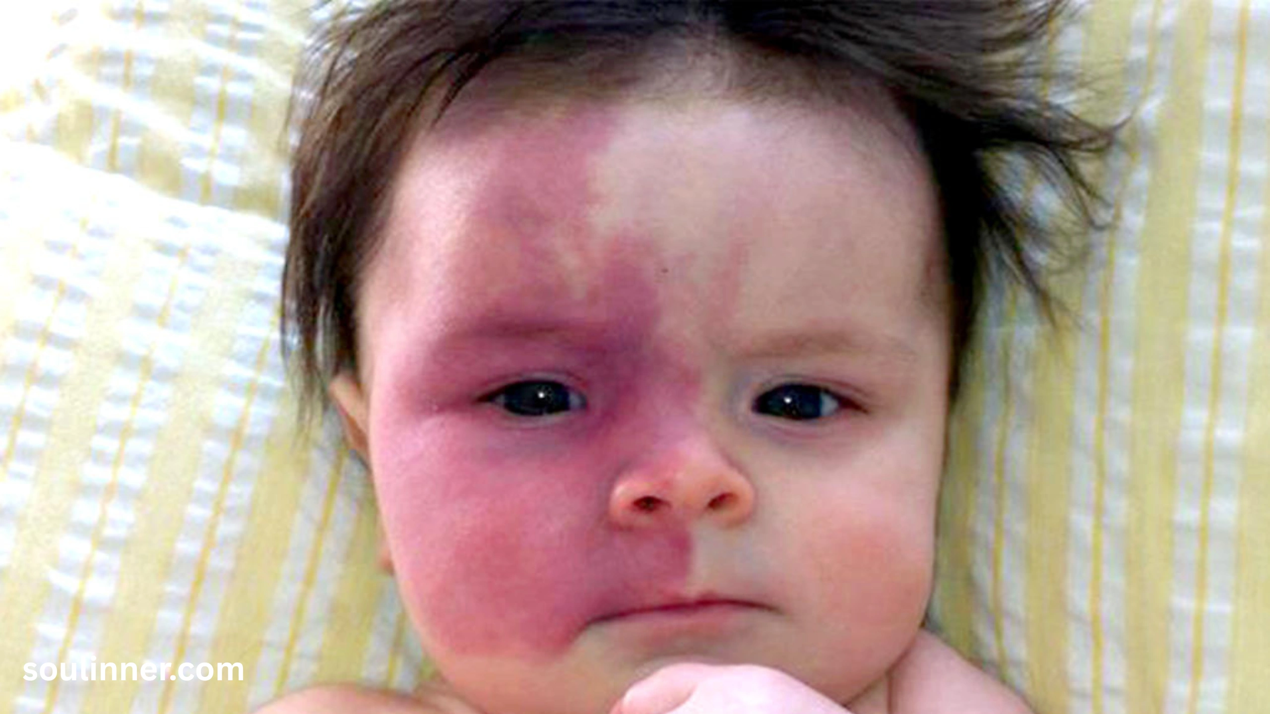 angel kiss birthmark spiritual meaning