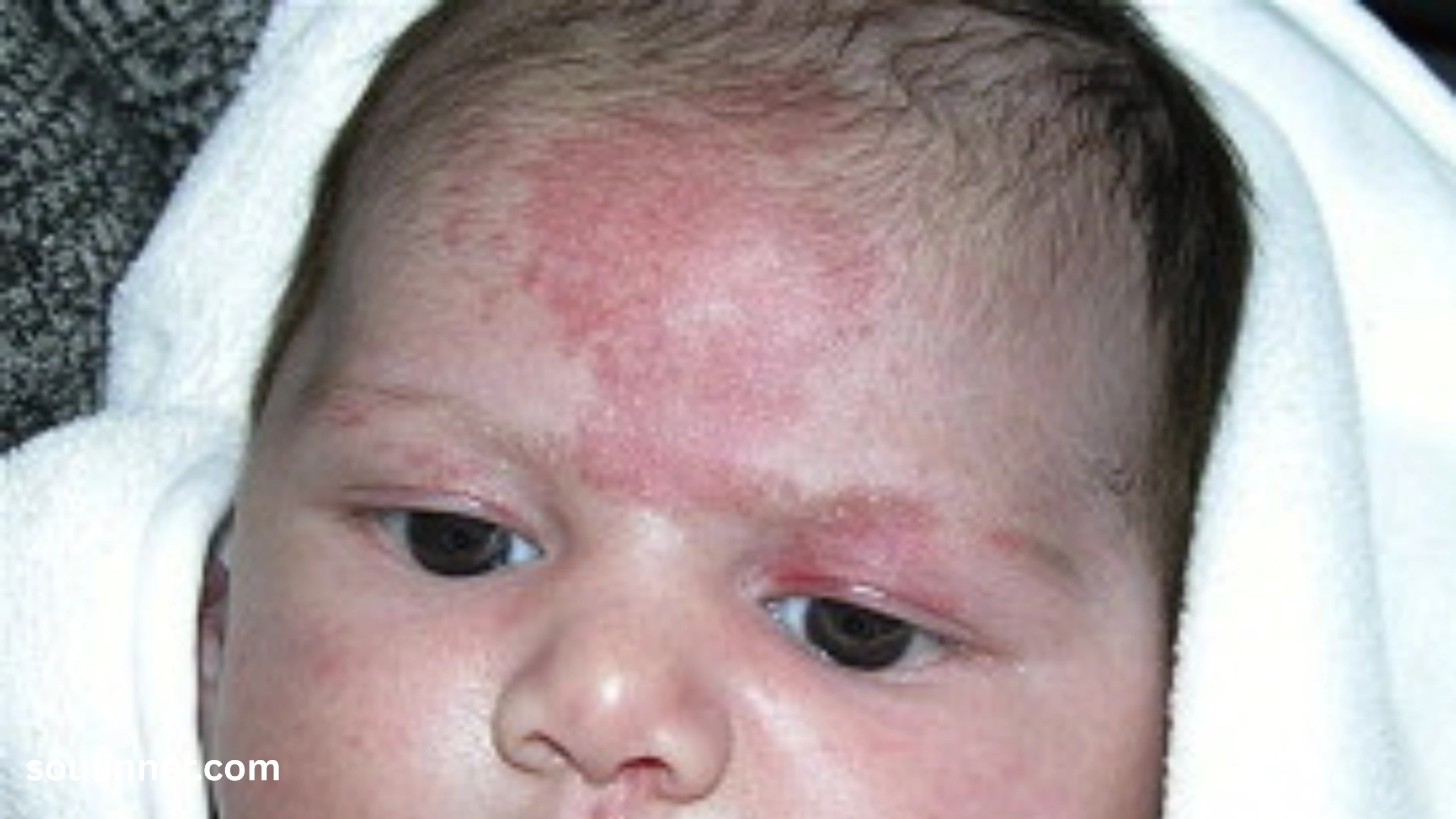 angel kiss birthmark spiritual meaning