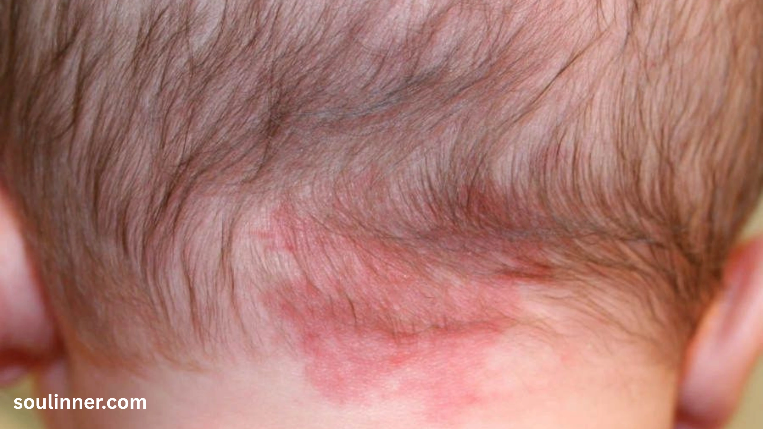 angel kiss birthmark spiritual meaning