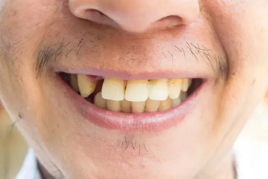 Missing Teeth