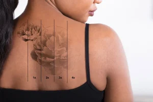 Tattoo Removal