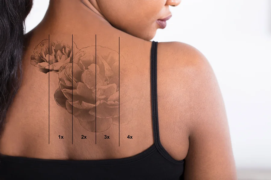 Tattoo Removal
