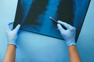 Ewing Sarcoma