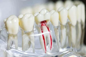 Root Canal