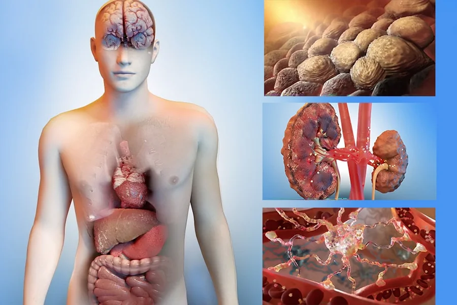 Hepatic Encephalopathy