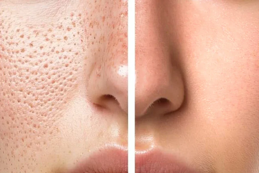 Niacinamide Gel